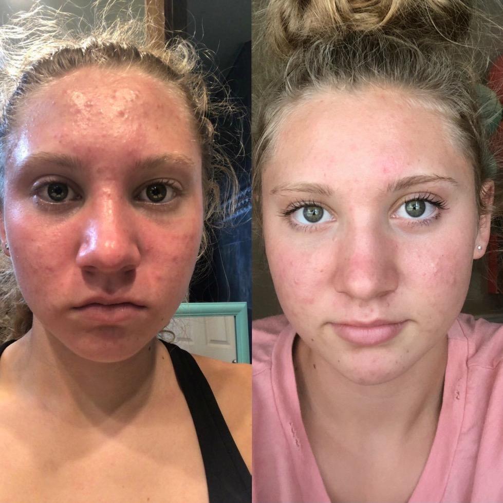 Acnetame Acne Pills- Vitamin Supplements for Acne Treatment- Natural Clear Skin from Hormonal Cystic Pimples- Oily Skin Vitamins Pill for Women, Teen, Men, & Adults 60 Tablets customer photo 2