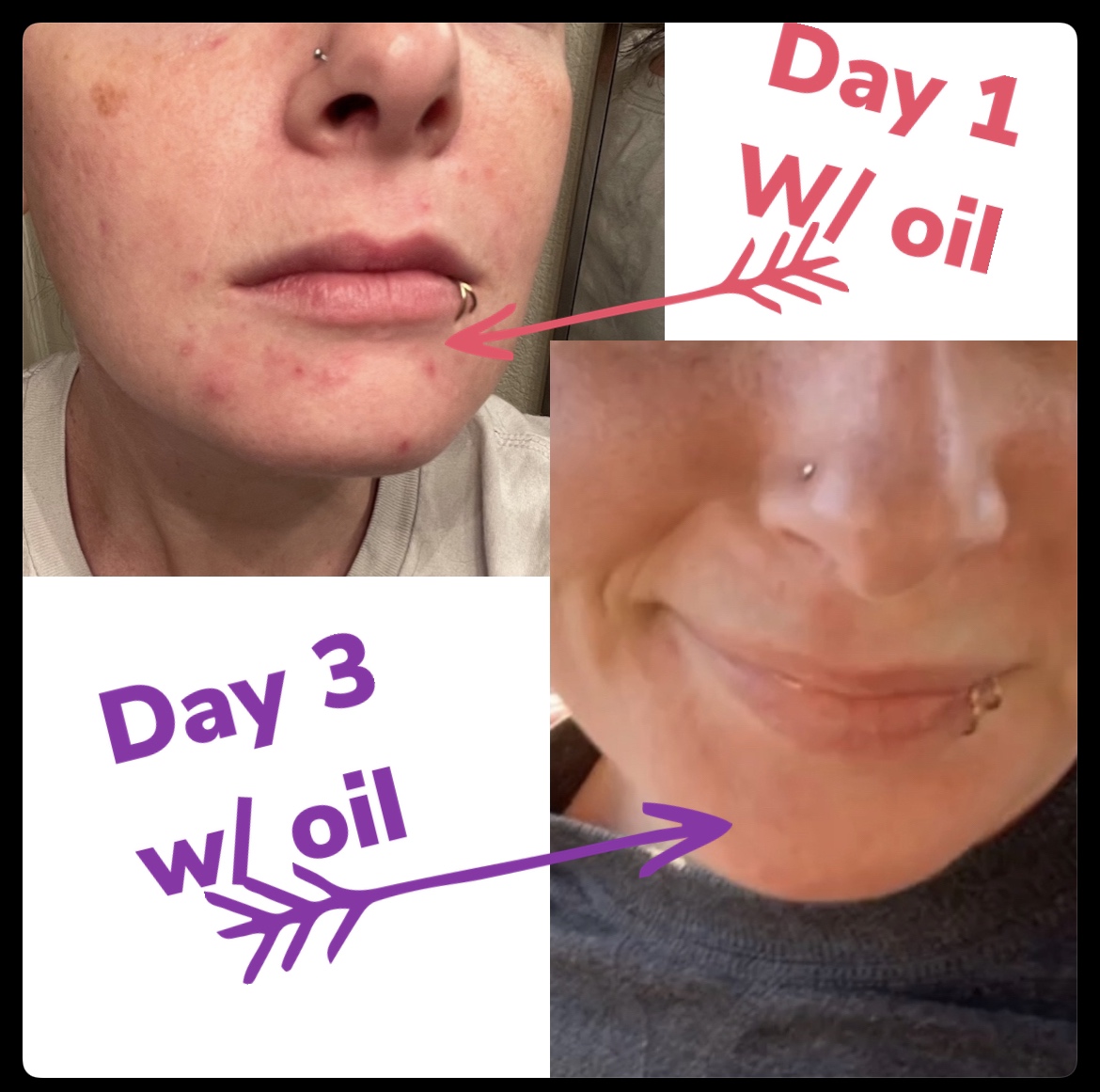 PUR360 Tamanu Oil - Best Treatment for Psoriasis, Eczema, Acne Scar, Rosacea - Relief for Dry, Scaly Skin, Scalp and More - Cold Pressed - Proven 100% Pure customer photo 2