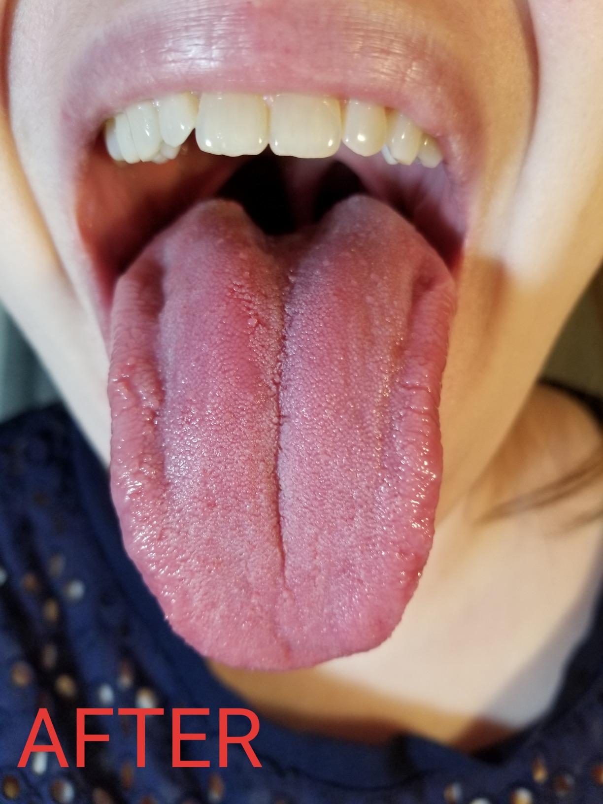 DenTek Orabrush Tongue Scraper, Gentle Tongue Cleaner Brush for Fresh Breath, 2 Count customer photo 2