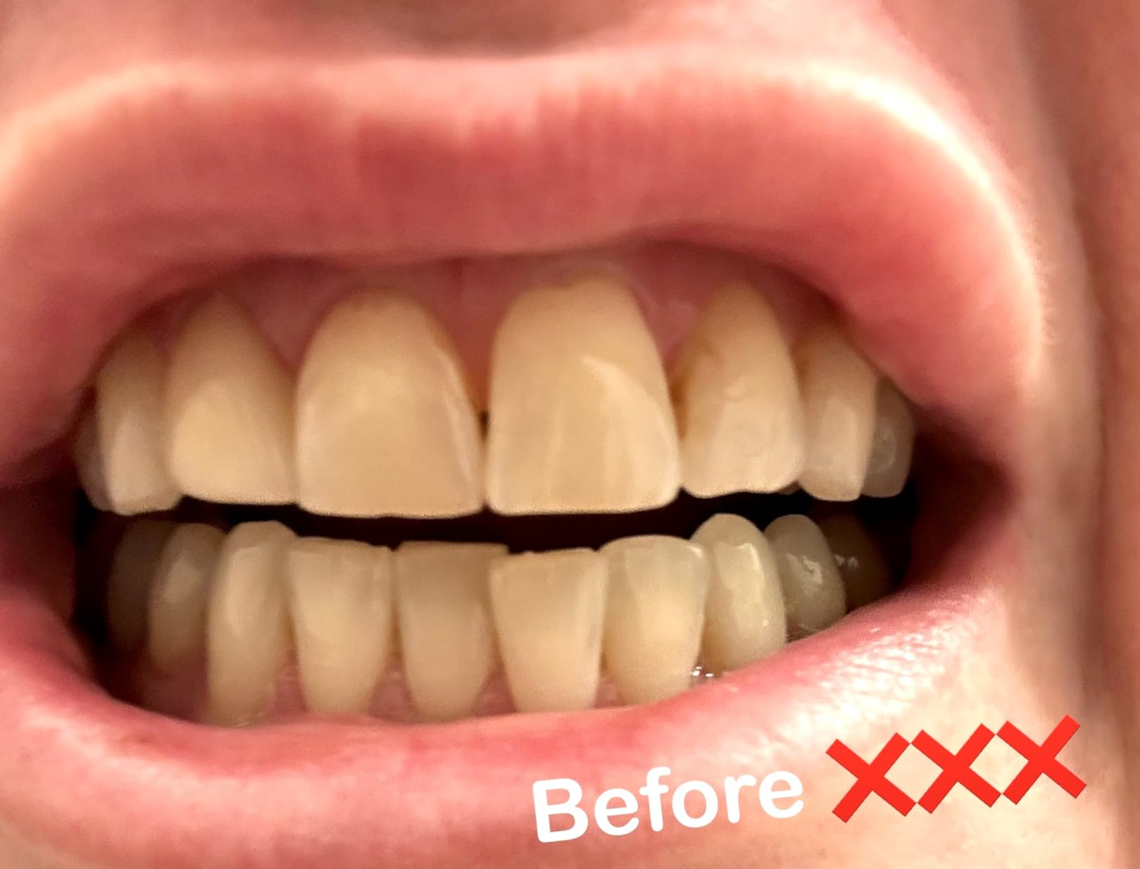 MasterMedi Nano Hydroxyapatite Whitening Toothpaste with Xylitol, Charcoal & Spearmint - Fluoride & SLS Free, Remineralizing Formula for Sensitive Teeth, Enamel Repair, 4 oz (Pack of 1) customer photo 2