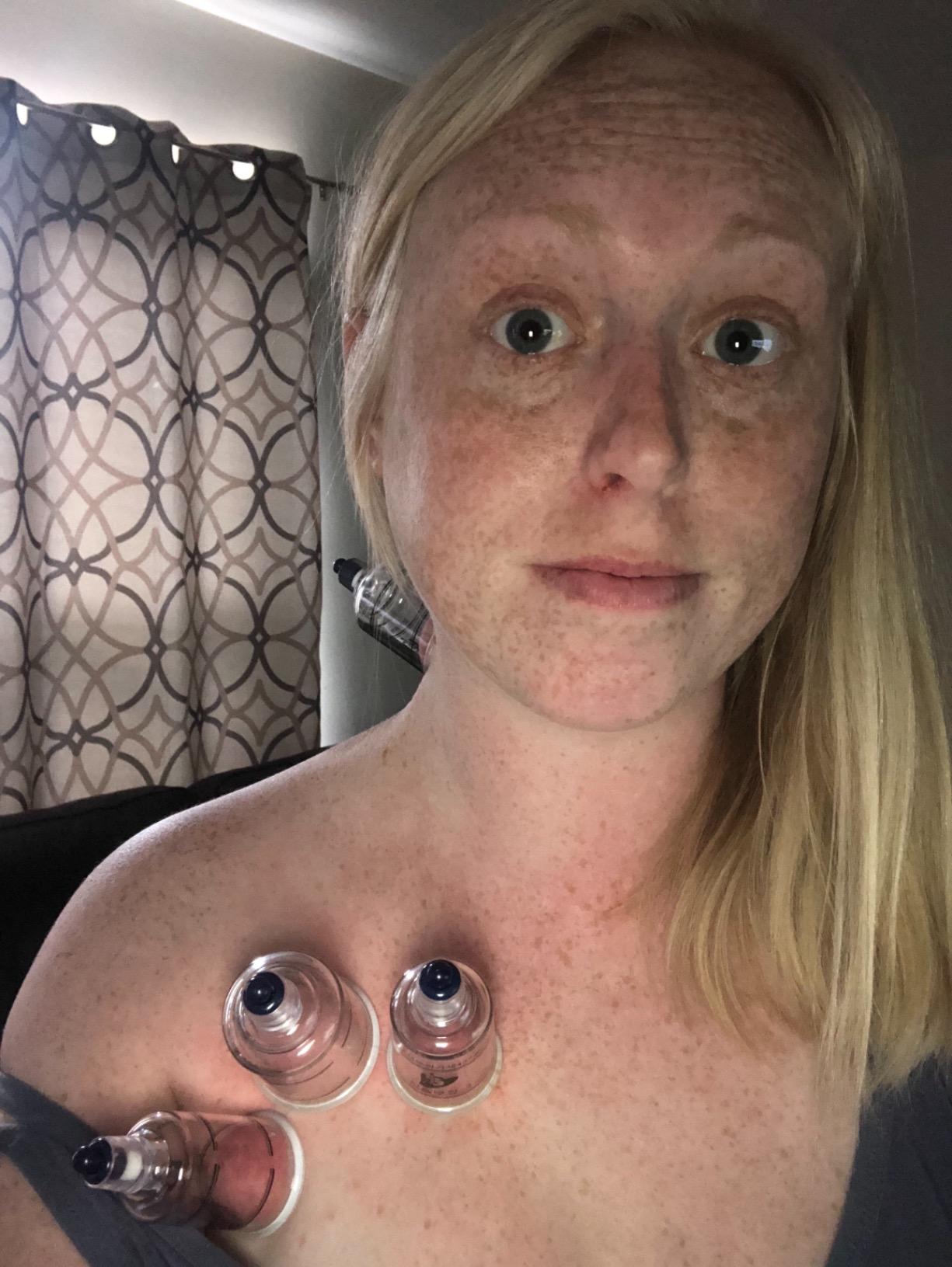 Hansol Professional Cupping Therapy Equipment Set with pumping handle 19 Cups / English Manual (Made in Korea) customer photo 2
