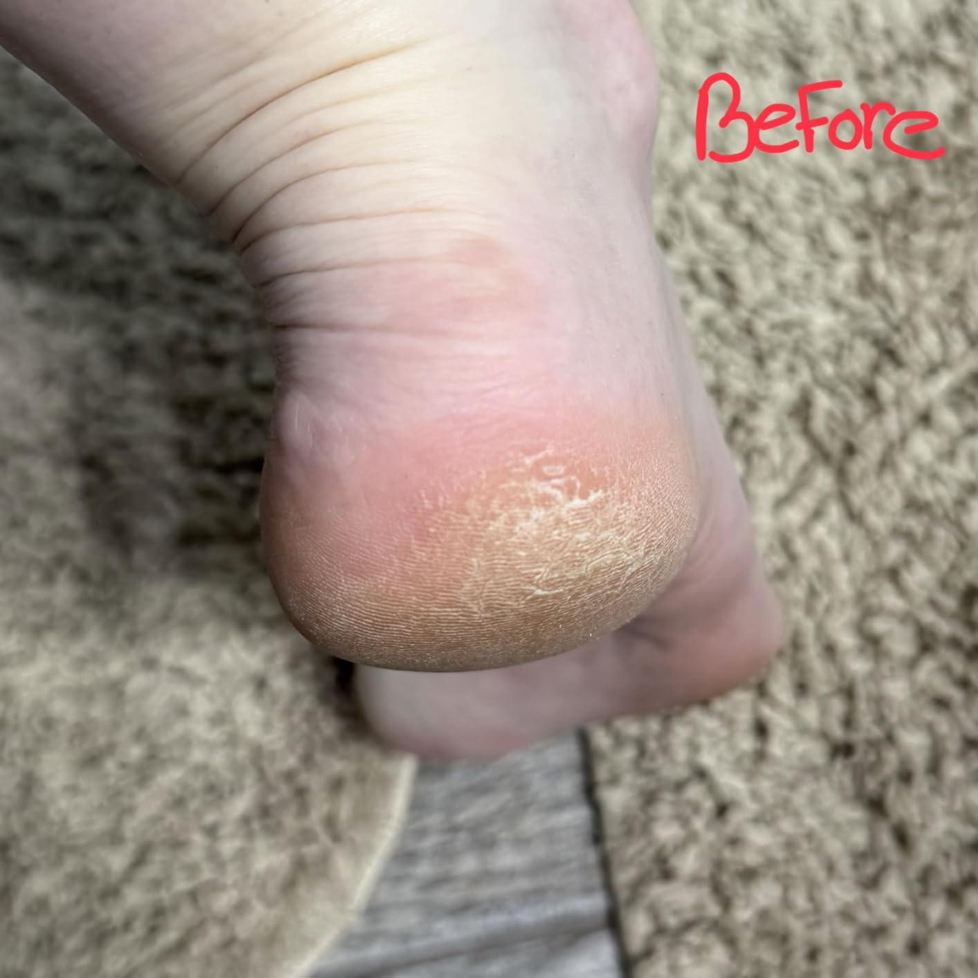 OKeeffes Healthy Feet Intense Renewal Cream, 3 oz Tube, 1-Pack | Chemically Exfoliates & Softens Extremely Callused Dry Feet, Urea & Alpha Hydroxy Acid Formula, Cracked Heel Relief customer photo 1