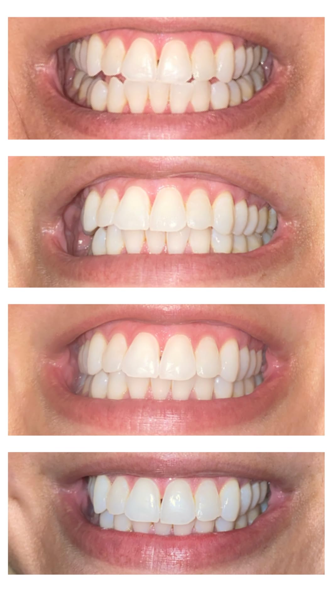iSmile Teeth Whitening Kit - LED Light, 35% Carbamide Peroxide, (3) 3ml Gel Syringes, (1) Remineralization Gel, and Tray customer photo 1