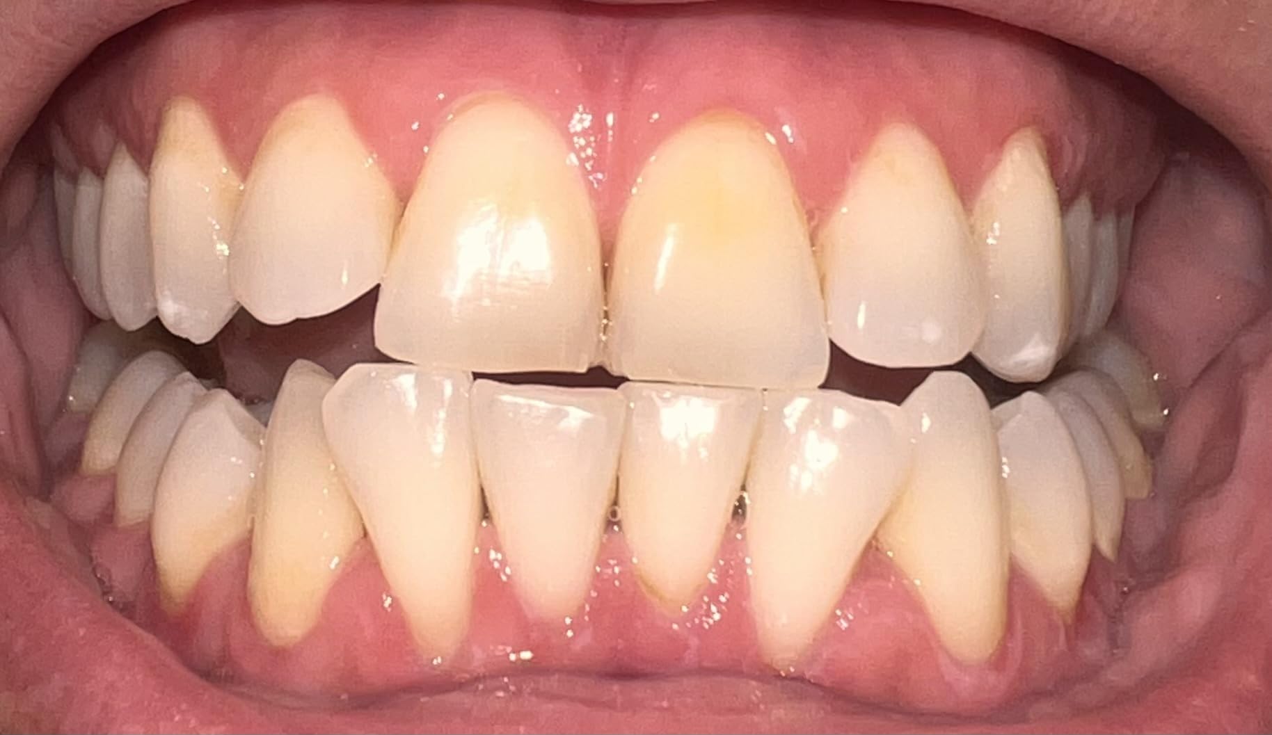 Crest 3D Whitestrips Age Renewal, 3D White, Teeth Whitening Strip Kit, 48 Strips (24 Count Pack), Crest Teeth Whitening Strips, Teeth Whitening Kit customer photo 1