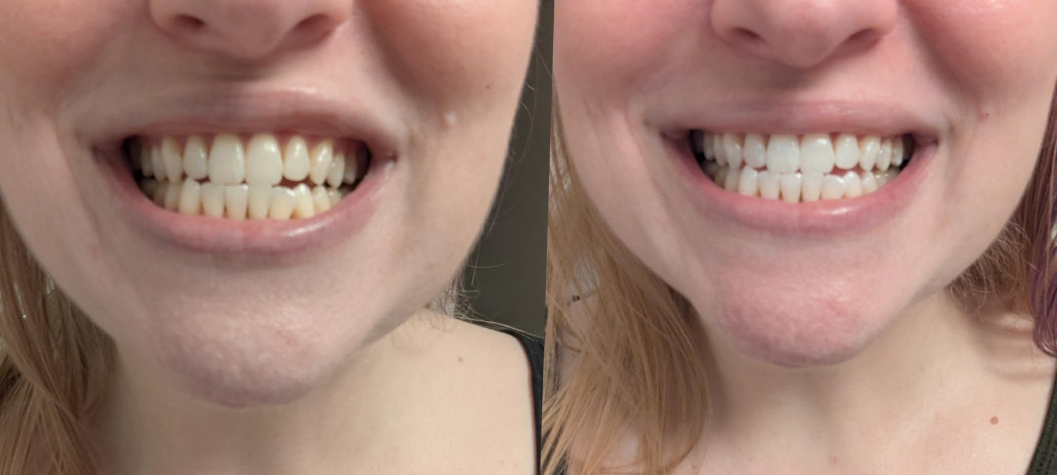 Crest 3D Whitestrips Professional Effects + LED Light - Teeth Whitening Kit, 1 Light + 20 Treatments, Each with 1 Upper/1Lower, 40 Strips customer photo 2