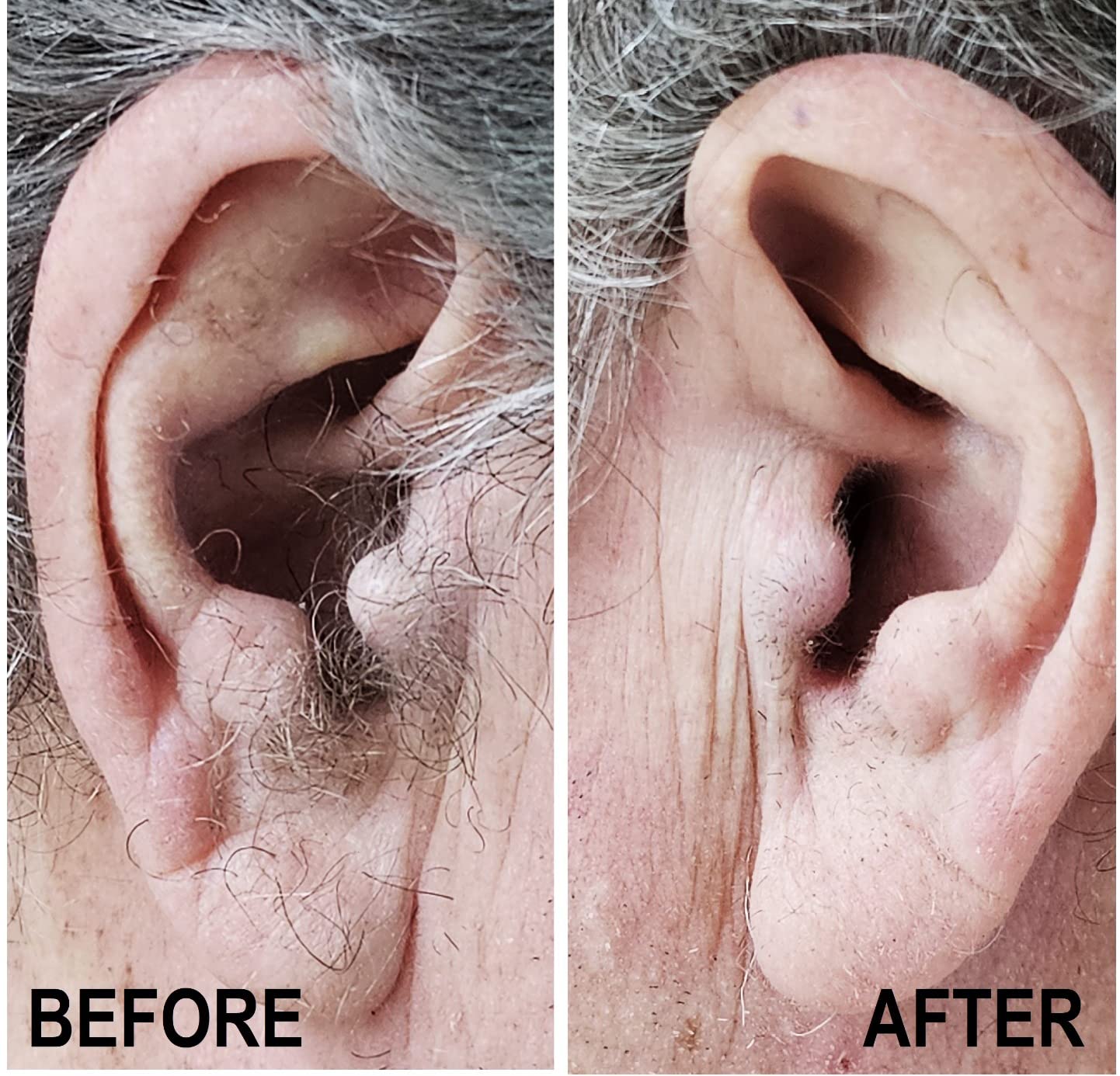 Philips Nose Trimmer 5000 for Nose, Ears, Eyebrows & Details | Protective Guard System, Dual-Sided Steel Blades, Eyebrow Combs, Rotary & Detail Trimmer, Washable, AA Battery, NT5600/62 customer photo 1