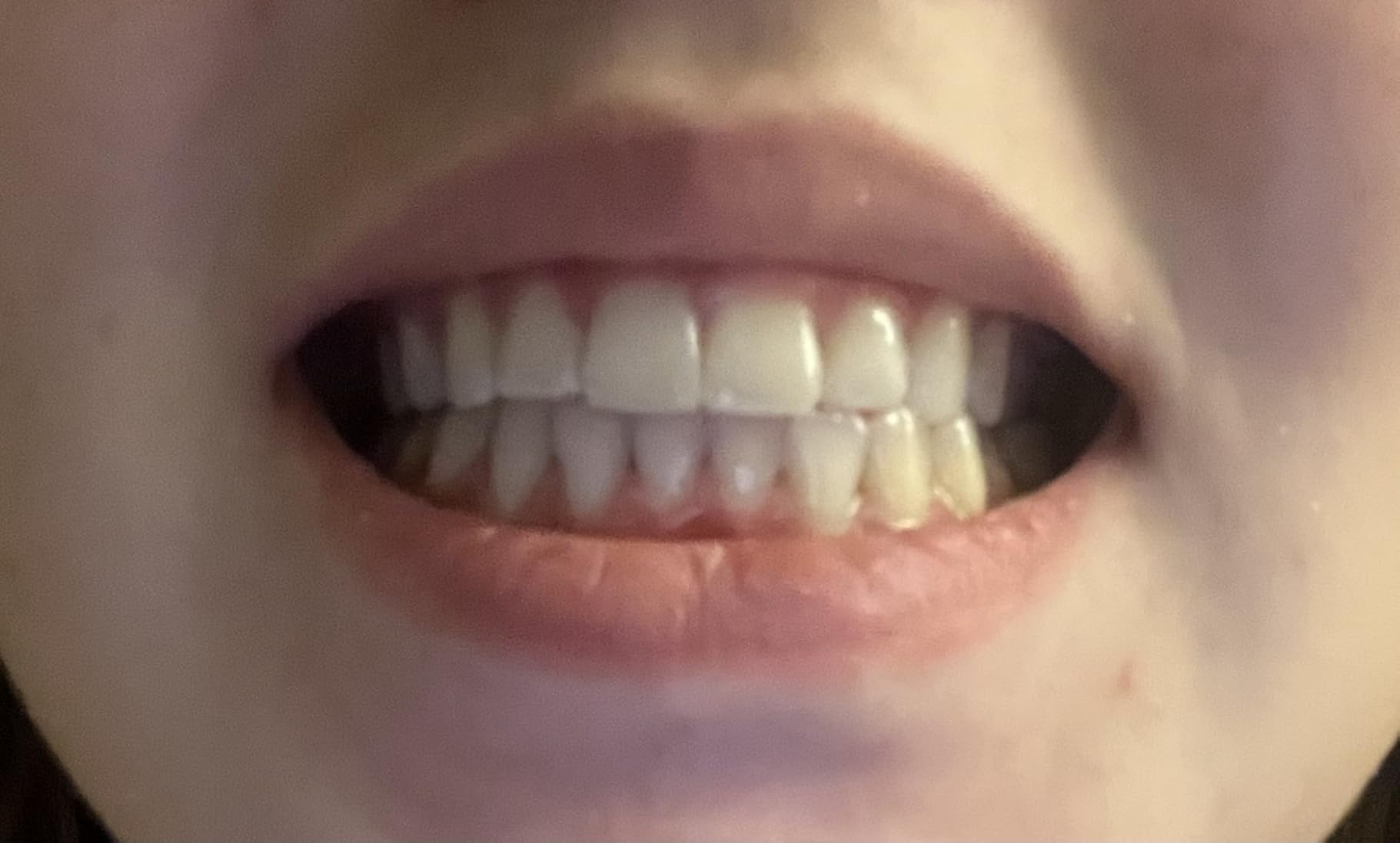Crest 3D Whitestrips Whitening Starter Kit - Teeth Whitening Kit, 10 Treatments, Each with 1 Upper/1Lower, 20 Strips - Crest 3DWhite Teeth Whitening Strips customer photo 1