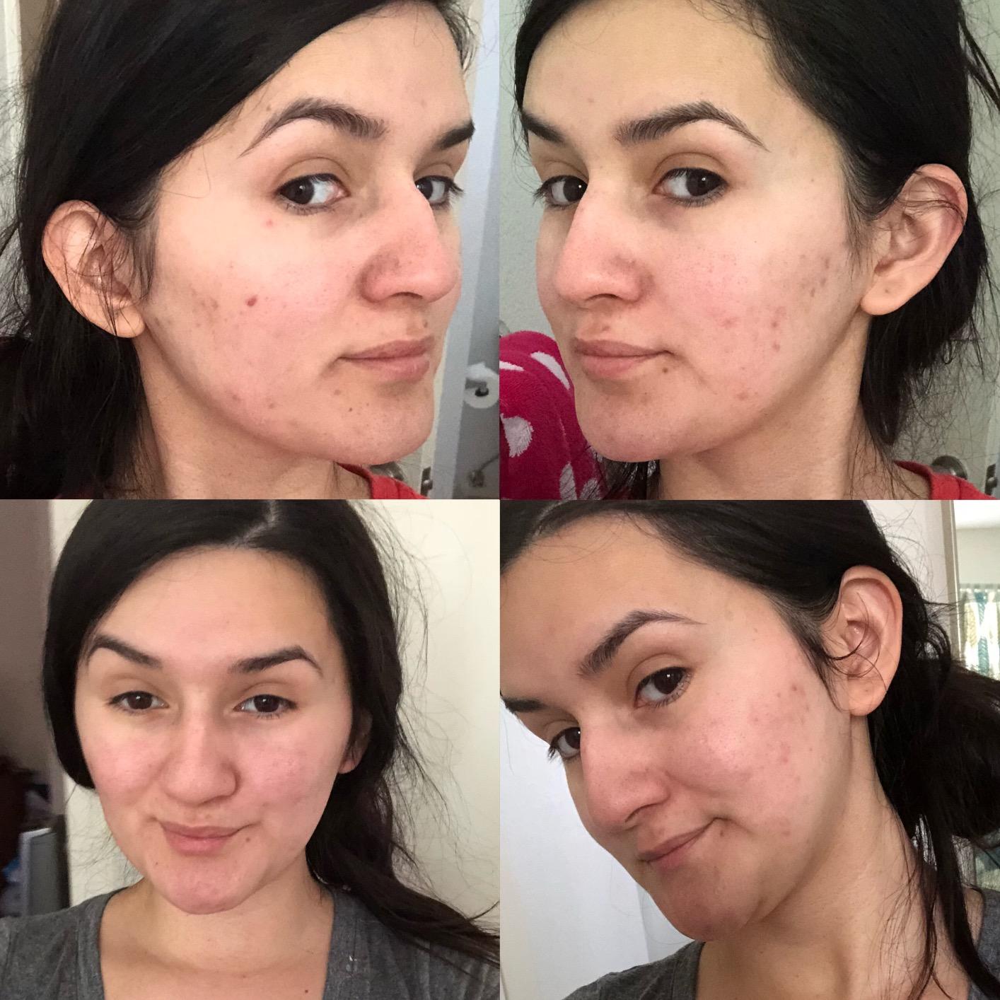 Era Organics Tea Tree Oil Face Wash - Salicylic Acid Cleanser for Oily Skin customer photo 2